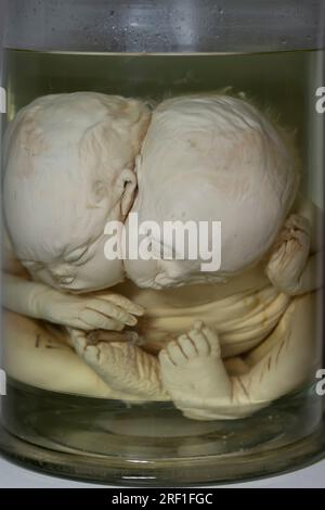 1. April 2023 - Gomel: Vollständig plastinierte siamesische Zwillinge auf einer anatomischen Ausstellung mit plastinierten Leichen. Einbalsamierte siamesische Zwillinge Stockfoto