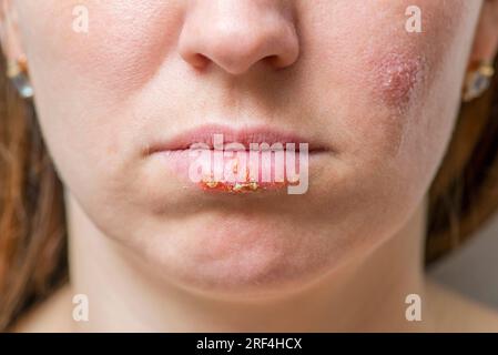 Nahaufnahme der weiblichen Lippen, die von Herpes-Virus betroffen sind. Stockfoto