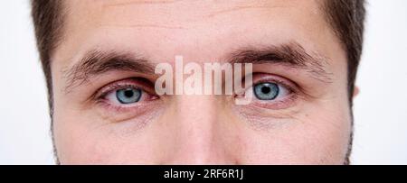 Nahaufnahme der leuchtend blauen Augen eines Mannes. Auge eines jungen Mannes mit Katarakt, Linsentrübung, Makro. Stockfoto