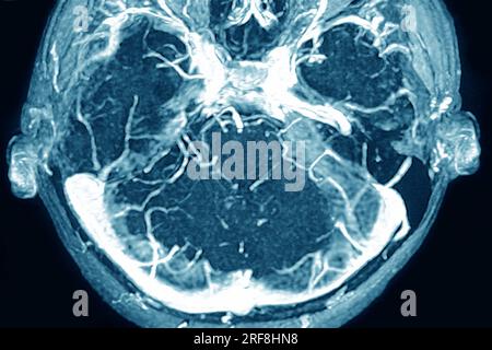 Thrombose der Hirnvenenhöhlen der Dura mater, dargestellt durch kraniale MRT-Angiographie. Stockfoto