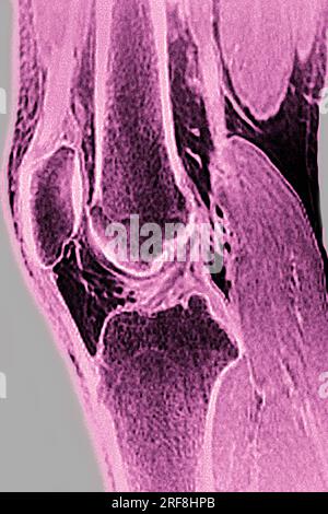 MRT-Darstellung des normalen Kniegelenks bei sagittaler Schnittentbindung. Stockfoto