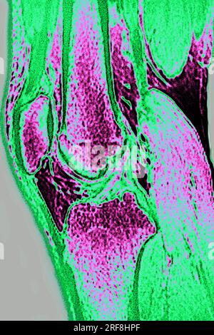 MRT-Darstellung des normalen Kniegelenks bei sagittaler Schnittentbindung. Stockfoto