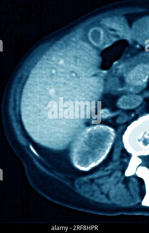 Lymphom, aufgedeckt durch Lymphadenopathie zwischen Leber und Gallenblase. Abdomen-Scan im Radialschnitt. Stockfoto