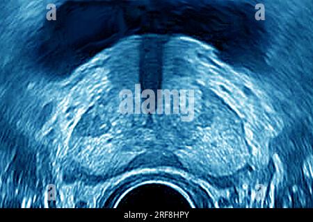 Prostata (gesunde Prostata), sonographisch in frontaler Sicht dargestellt. Stockfoto