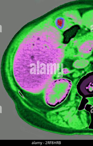 Lymphom, aufgedeckt durch Lymphadenopathie zwischen Leber und Gallenblase. Abdomen-Scan im Radialschnitt. Stockfoto