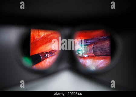 Hysterektomie im Operationssaal mit einem Roboter, Sicht des Chirurgen von der Robotersteuerkonsole. Stockfoto