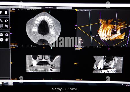 Kieferscanner zur Implantatplatzierung in der Zahnheilkunde. Stockfoto