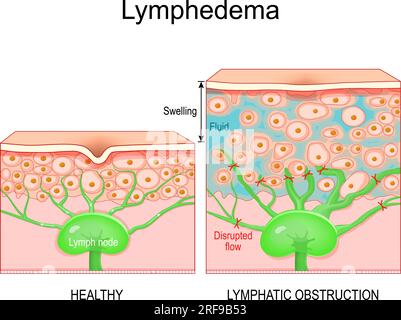 Lymphödem. Querschnitt einer menschlichen Haut mit gesunden Lymphgefäßen und Schwellungen, die Lymphödeme verursacht haben. Nahaufnahme von Hautzellen und Lymph-Nr. Stock Vektor