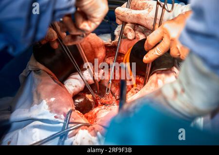 Nahaufnahme der Hände von Chirurgen, die eine komplexe Operation in der offenen Brusthöhle des Patienten durchführen. Einsatz chirurgischer Instrumente und c Stockfoto