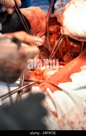 Nahaufnahme der Hände von Chirurgen, die eine komplexe Operation in der offenen Brusthöhle des Patienten durchführen. Einsatz chirurgischer Instrumente und c Stockfoto