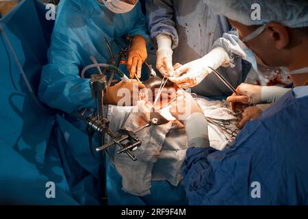 Nahaufnahme der Hände von Chirurgen, die eine komplexe Operation in der offenen Brusthöhle des Patienten durchführen. Einsatz chirurgischer Instrumente und c Stockfoto