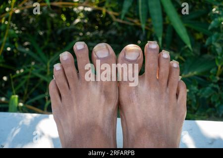 Oktober 14. 2022 Uttarakhand, Indien. Vernachlässigte Fussnägel eines indischen Erwachsenen mit unhygienischen Fussbedingungen. Konzept der Selbstpflege und Körperhygiene. Stockfoto