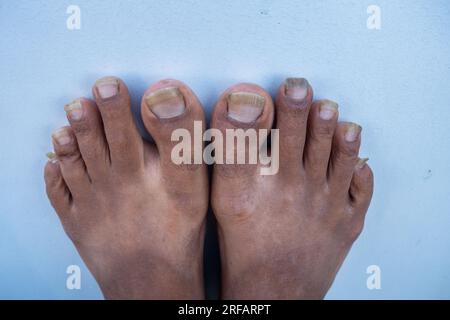 Oktober 14. 2022 Uttarakhand, Indien. Vernachlässigte Fussnägel eines indischen Erwachsenen mit unhygienischen Fussbedingungen. Konzept der Selbstpflege und Körperhygiene. Stockfoto