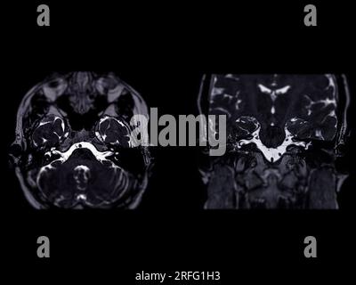 MRT-Hirnscan mit der axialen und koronalen Ansicht des inneren Gehörgangs (IAC). Stockfoto