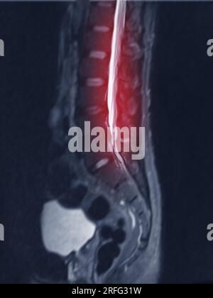 MRT L-S-Wirbelsäule oder Lendenwirbelsäule Sagittall T2 FS-Ansicht zur Diagnose der Rückenmarkskompression. Stockfoto