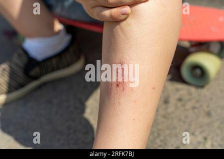 Abrieb am Bein eines Kindes, wenn es beim Skateboard-Fahren auf einen Asphaltpfad fällt. Der Junge ist beim Skateboard-Fahren gestürzt. Extremsport. Stockfoto