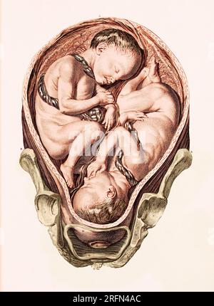 Eine Illustration von Zwillingen in utero aus Einem Satz anatomischer Tische, mit Erläuterungen und einer Abkürzung der Hebammenpraxis von William Smellie, 1754. Gefärbt. Stockfoto