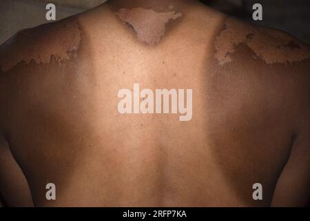 Sonnenbrand auf dem Rücken eines Mannes. Kräftige Bräune im Mann. Rote Hände und Rücken. Wunde Haut, Blasen. Kein Sonnenschutz Stockfoto