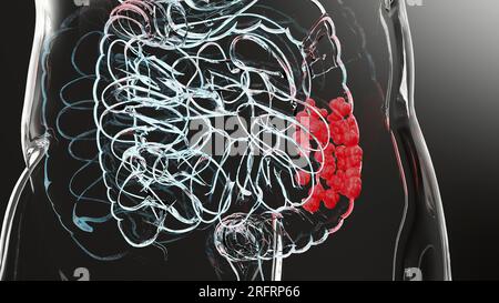 Darmkrebs oder kolorektaler Tumor, Darmkrebs, entzündliche Darmerkrankung, Darmschmerzen, Zöliakie, Infektionen, Duplikate, Zellen werden erweitert Stockfoto