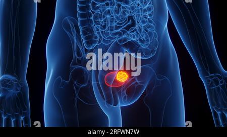 Harnblasenkarzinom, Illustration Stockfoto