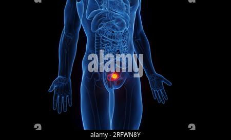 Harnblasenkarzinom, Illustration Stockfoto