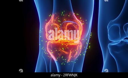 Entzündete Kniegelenksheilung, Illustration Stockfoto