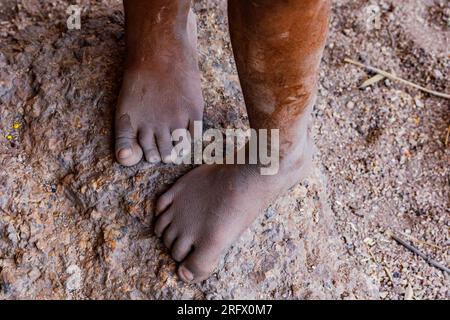 Dunkle, gehäutete Füße eines Jungen unter den Buschmännern in Namibia, Afrika Stockfoto