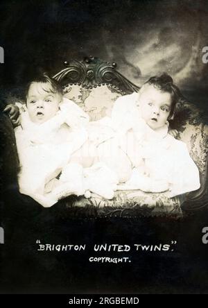 Die "Brighton United Twins" - die berühmten Schwestern Daisy und Violet Hilton (1908-1969). Die Zwillinge wurden in Europa als Kinder ausgestellt und besuchten in den 1920er- und 1930er-Jahren die Sideshow, das Varieté und die amerikanische Burlesque-Rennstrecke der USA. Sie waren am bekanntesten für ihre Filmvorführungen in Freaks und die Biografie „Chained for Life“ (1951). Stockfoto