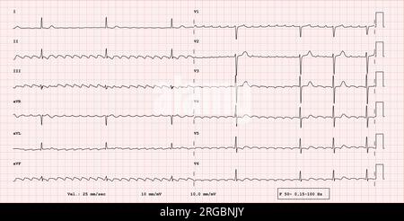 EKG-Beispiel für einen 12-Kanal-Rhythmus, Vorhofflattern mit langsamer Kammerfrequenz, reale Untersuchung Stockfoto