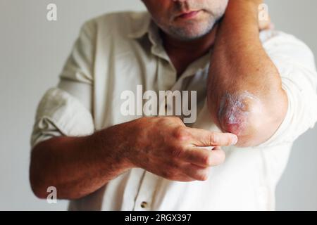 Auftragen eines Creme-Weichmachers auf trockene schuppige Haut wie bei der Behandlung von Psoriasis, Ekzemen und anderen trockenen Hauterkrankungen Stockfoto