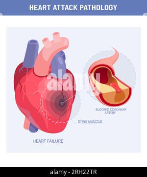 Herzinfarkt und Atherosklerose. Vektor eines geschädigten Herzens, Querschnitt einer Koronararterie mit atherosklerotischer Plaque Stock Vektor