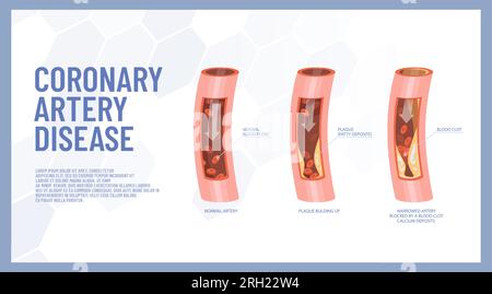Pathologie der koronaren Herzkrankheit, Vektor von 3 Stadien der Atherosklerose der Herzarterien Stock Vektor