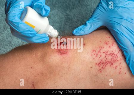 Ein Arzt behandelt die Wunde eines Mannes, der von einem Elektroroller gefallen ist. Verletzungsgefahr durch Elektroroller. Stockfoto