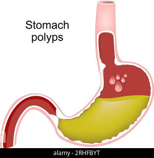 Magenpolypen. Querschnitt des menschlichen Magens mit Magenpolypen. Hyperplasie der Magenschleimhaut. Bakterielle Infektion durch Helicobacter pylori. Stock Vektor