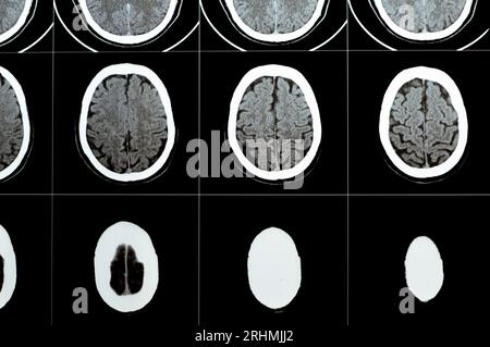 Mehrschicht-CT-Scan des Gehirns mit großem Hirnstamm und semiovalen Hämatom des rechten Zentrums, normalen hinteren Fossa-Strukturen, normaler Vent-Größe Stockfoto