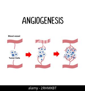 Angiogenese: Die Bildung neuer Blutgefäße, die oft durch Krebszellen stimuliert werden, um eine ausreichende Versorgung mit Nährstoffen für das Tumorwachstum zu gewährleisten. Stock Vektor