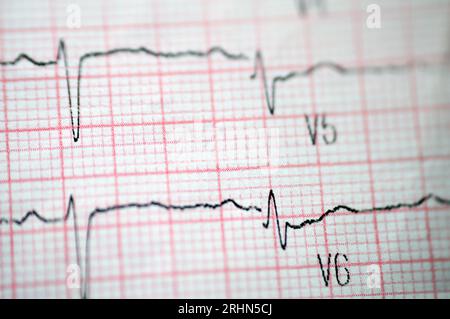 Ein EKG, ein Diagramm, das die Elektrizität des Herzens zieht und eine Vorstellung von der Herzerkrankung und dem Rhythmus gibt und alle ausschließt Stockfoto