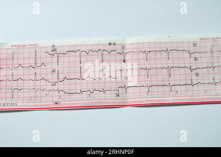 Ein EKG, ein Diagramm, das die Elektrizität des Herzens zieht und eine Vorstellung von der Herzerkrankung und dem Rhythmus gibt und alle ausschließt Stockfoto