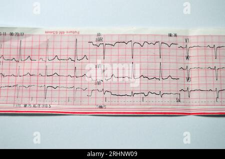 Ein EKG, ein Diagramm, das die Elektrizität des Herzens zieht und eine Vorstellung von der Herzerkrankung und dem Rhythmus gibt und alle ausschließt Stockfoto