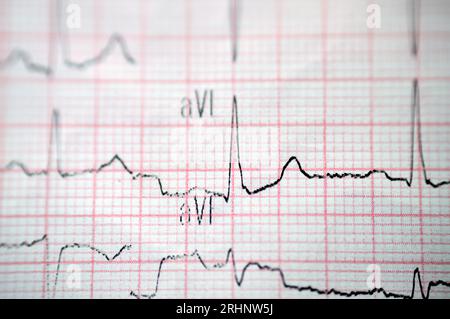 Ein EKG, ein Diagramm, das die Elektrizität des Herzens zieht und eine Vorstellung von der Herzerkrankung und dem Rhythmus gibt und alle ausschließt Stockfoto