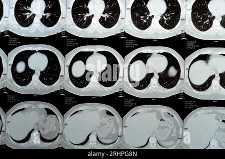 Mehrschicht-CT-Scan der Brust mit normaler Untersuchung, normalem Lungenbild, Parenchym, Lungengefäß, mediastinalen Strukturen, nein Stockfoto