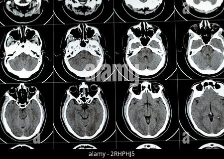 Mehrschicht-CT-Scan des Gehirns mit großem Hirnstamm und semiovalen Hämatom des rechten Zentrums, normalen hinteren Fossa-Strukturen, normaler Vent-Größe Stockfoto