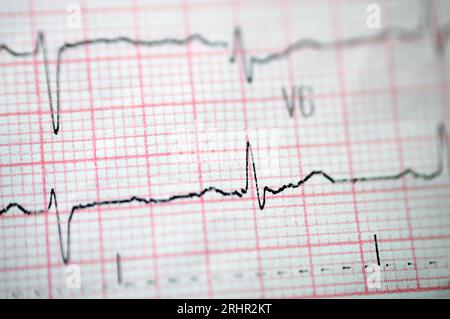 Ein EKG, ein Diagramm, das die Elektrizität des Herzens zieht und eine Vorstellung von der Herzerkrankung und dem Rhythmus gibt und alle ausschließt Stockfoto