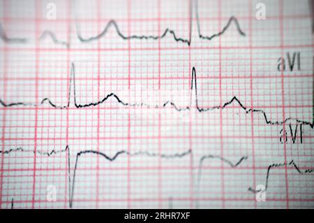 Ein EKG, ein Diagramm, das die Elektrizität des Herzens zieht und eine Vorstellung von der Herzerkrankung und dem Rhythmus gibt und alle ausschließt Stockfoto