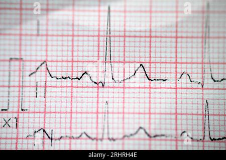 Ein EKG, ein Diagramm, das die Elektrizität des Herzens zieht und eine Vorstellung von der Herzerkrankung und dem Rhythmus gibt und alle ausschließt Stockfoto