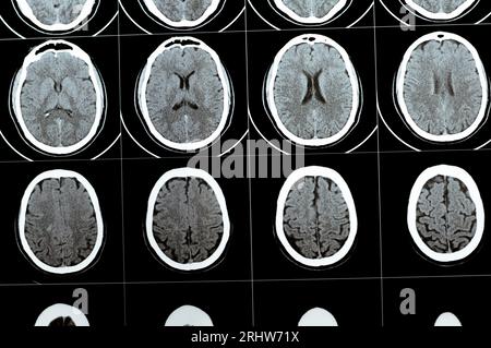 Mehrschicht-CT-Scan des Gehirns mit großem Hirnstamm und semiovalen Hämatom des rechten Zentrums, normalen hinteren Fossa-Strukturen, normaler Vent-Größe Stockfoto