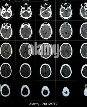 Gehirn-CT-Scan mit Hirnstamm-Kavernom, semiovale Entwicklungsvenenanomalie des rechten Zentrums, intrazerebralem Hämatom, schwacher Hypodichter Läsion in m Stockfoto