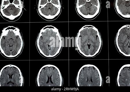 Gehirn-CT-Scan mit Hirnstamm-Kavernom, semiovale Entwicklungsvenenanomalie des rechten Zentrums, intrazerebralem Hämatom, schwacher Hypodichter Läsion in m Stockfoto