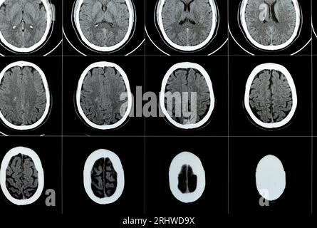 Mehrschicht-CT-Scan des Gehirns mit großem Hirnstamm und semiovalen Hämatom des rechten Zentrums, normalen hinteren Fossa-Strukturen, normaler Vent-Größe Stockfoto