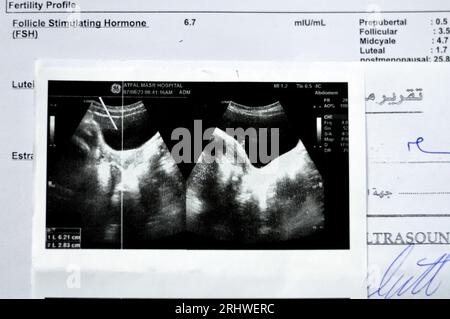 Kairo, Ägypten, 9. August 2023: Diagnostische pelviabdominelle Sonographie für ein junges Teenager-Mädchen mit normaler Nierenfunktion ohne ston Stockfoto